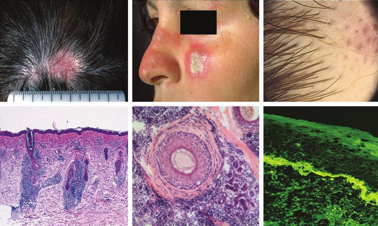Diagnosis of primary cicatricial alopecia, M.J. Harries et al. 493 Fig 10. Chronic cutaneous lupus erythematosus (CCLE). (a) Scalp CCLE with predominant inflammation in the centre of the lesion.