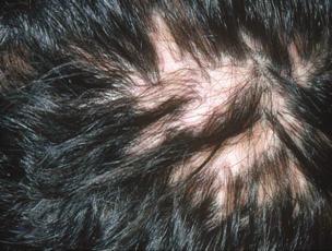 494 Diagnosis of primary cicatricial alopecia, M.J. Harries et al. Fig 11.