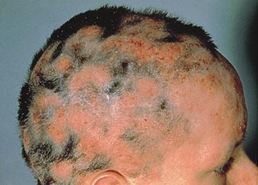 106 courtesy of Canfield Publishing). Fig 13. Alopecia mucinosa (AM).