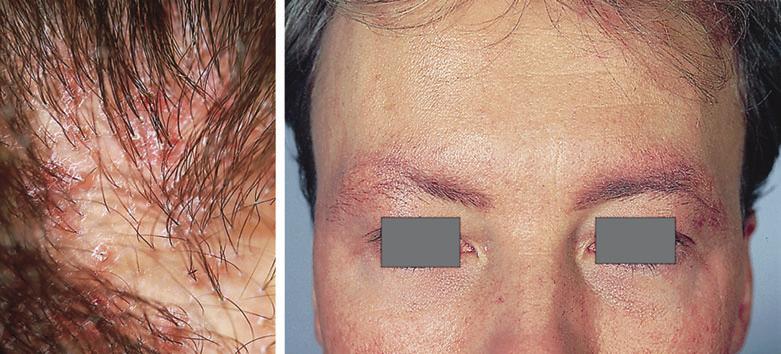 Diagnosis of primary cicatricial alopecia, M.J. Harries et al. 495 Fig 14. Keratosis follicularis spinulosa decalvans (KFSD). (a) Perifollicular hyperkeratosis is often prominent in KFSD.