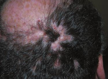 496 Diagnosis of primary cicatricial alopecia, M.J. Harries et al. Fig 17. Acne keloidalis nuchae (AKN). (a) Mild moderate AKN with numerous firm follicular papules over the occipital scalp.