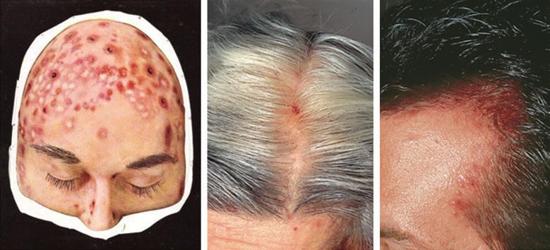 Diagnosis of primary cicatricial alopecia, M.J. Harries et al. 497 Fig 18. Acne necrotica varioliformis (ANV). (a) Moulage of ANV. (b, c) Typical lesions of ANV. Fig 19.