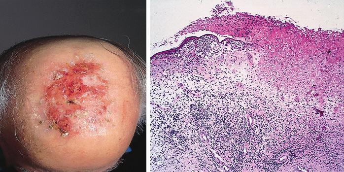 (b) Nonspecific histology showing eroded skin with a dense mixed inflammatory infiltrate (haematoxylin and eosin; original magnification 100).