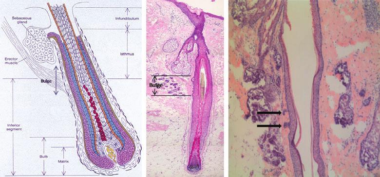 the hair follicles are destroyed and replaced with scar-like fibrous tissue (Fig. 1). 7,9 14 Primary vs.