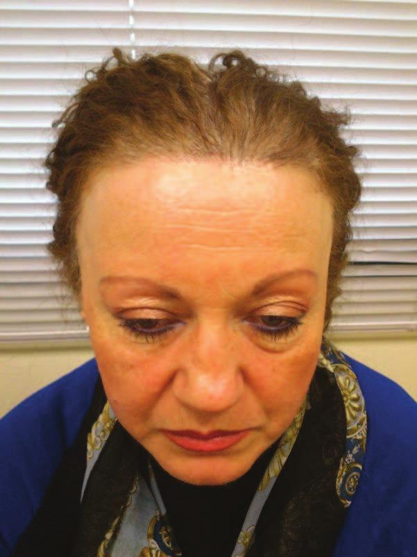 Clinical presentation Recession of the frontal and temporal hairline Patients diagnosed with this condition, typically present a symmetric, at times irregular (moth eaten) band like