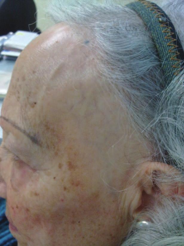 At the alopecic area, the typical changes consist of atrophic, smooth, shiny and pale skin.