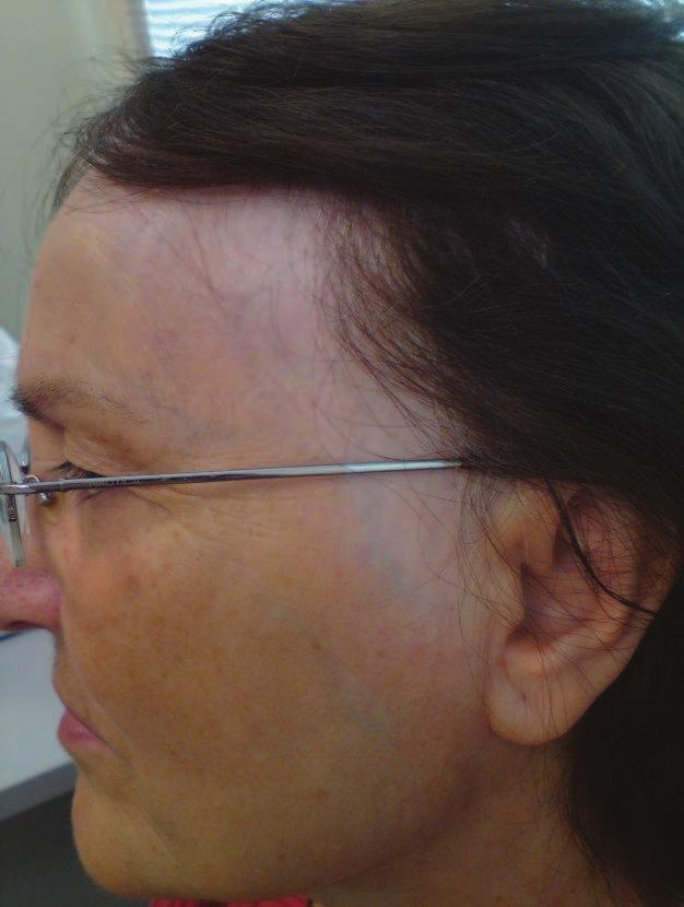 In FFA patients, the skin of the forehead has a different color from the hyperpigmented skin (caused by sun damage) of normal people. The demarcated line indicates the site of the initial hairline.