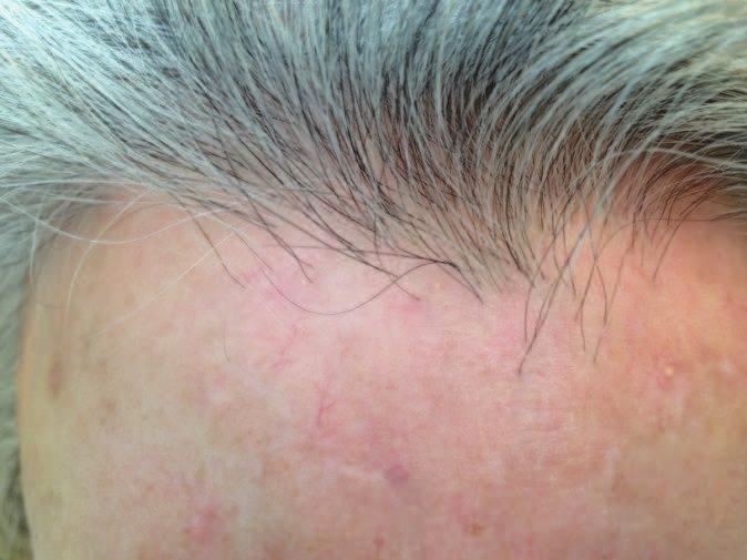 This clinical finding described initially by Tosti and others (27) as a sign of active discoid lupus erythematosus of the scalp.