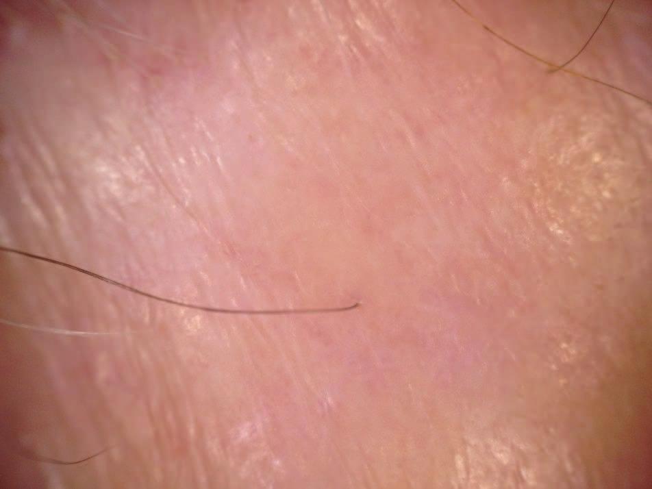 Regarding the eyebrow area, trichoscopy shows regularly distributed red or gray dots throughout the course of the disease, with some tendency toward a loss of follicular openings in the advanced