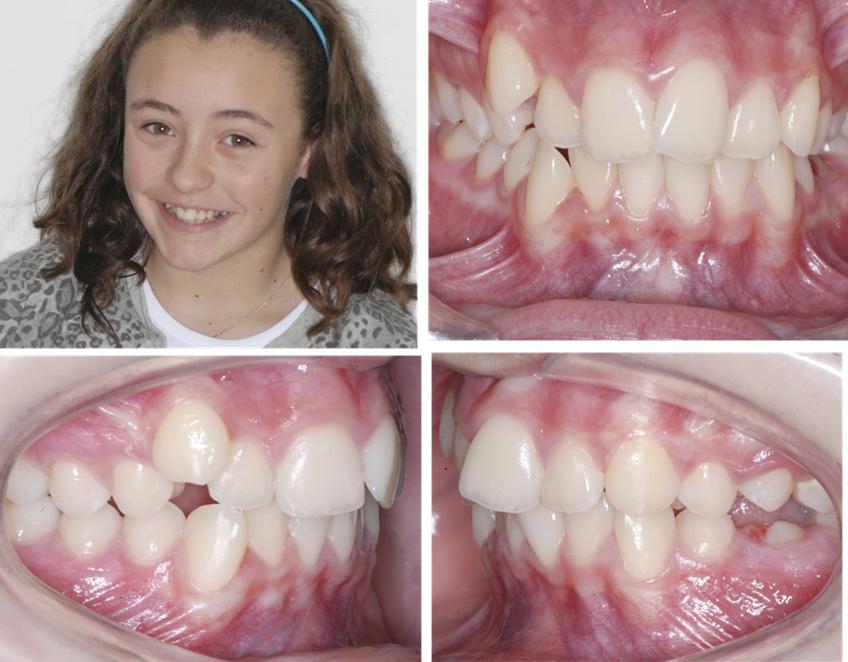 Case Report 2 A 15-year-old Caucasian female, M.A. presented with a class I incisor relationship on a class I skeletal base complicated by moderate crowding in both the upper and lower arches.