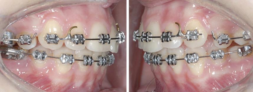The treatment plan consisted of extractions of the upper first premolars and the lower secondpremolars followed by upper and lower fixed appliances. Treatment commenced in April 2009 and the upper 0.