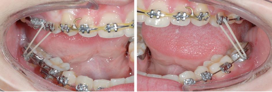 8 mm, 126 grams were placed on a full-time basis. Molar correction was completed in September 2010.