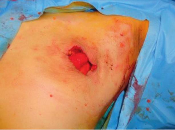 Patients were referred to receive suitable adjuvant chemo and/or radiotherapy according to the final pathology reported. Results Figure 5 Axillary dissection through the circumareolar incision.