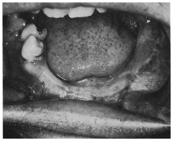 At operation the 313456 were extracted and the lesion excised. The underlying bone was thoroughly curetted and the area allowed to granulate.
