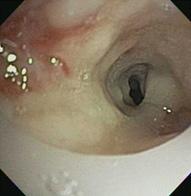 Topical mitomycin C was applied at the site of granulation tissue on the third bronchoscopic evaluation with a resulting tracheal diameter greater than 75% normal (Figure 7).