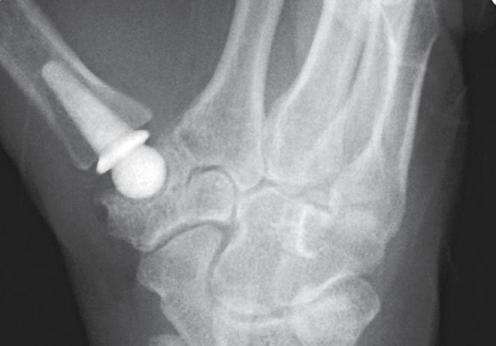 PyroCarbon thumb joint replacement Join the thousands of satisfied patients who have returned to normal and productive lives after joint replacement surgery using Integra s cutting edge PyroCarbon