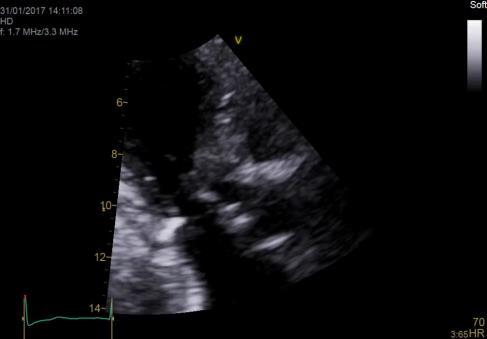 Systolic Anterior Motion (SAM) Anterior motion of Mitral leaflets in systole