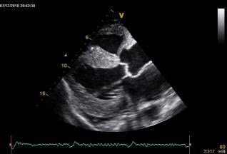Cardiac Amyloidosis LVH