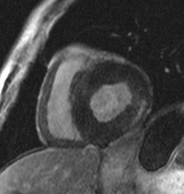 Myocardial Fibrosis 50% of patients display fibrosis assessed by MRI late