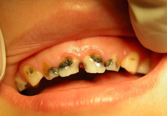 Effects of Poor Oral Health Symptoms and conditions: Infection Pain Disturbance of sleep Withdrawal from