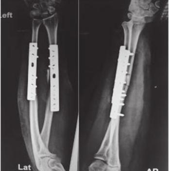 Figure 1: Immediate Postoperative radiograph showing radius ulna fractures stablised by DCP plate.