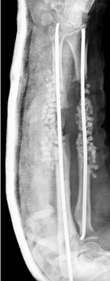 The third radiograph showed removal of ulna plate and application of external fixation.