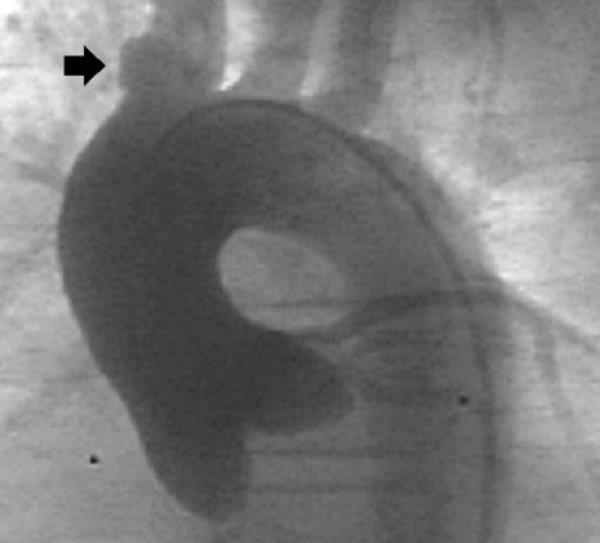 normal. Aortic root angiography showed no evidence of an aortopulmonary window. The aortic arch was left-sided with a prominent right innominate artery diverticulum (fig 2).