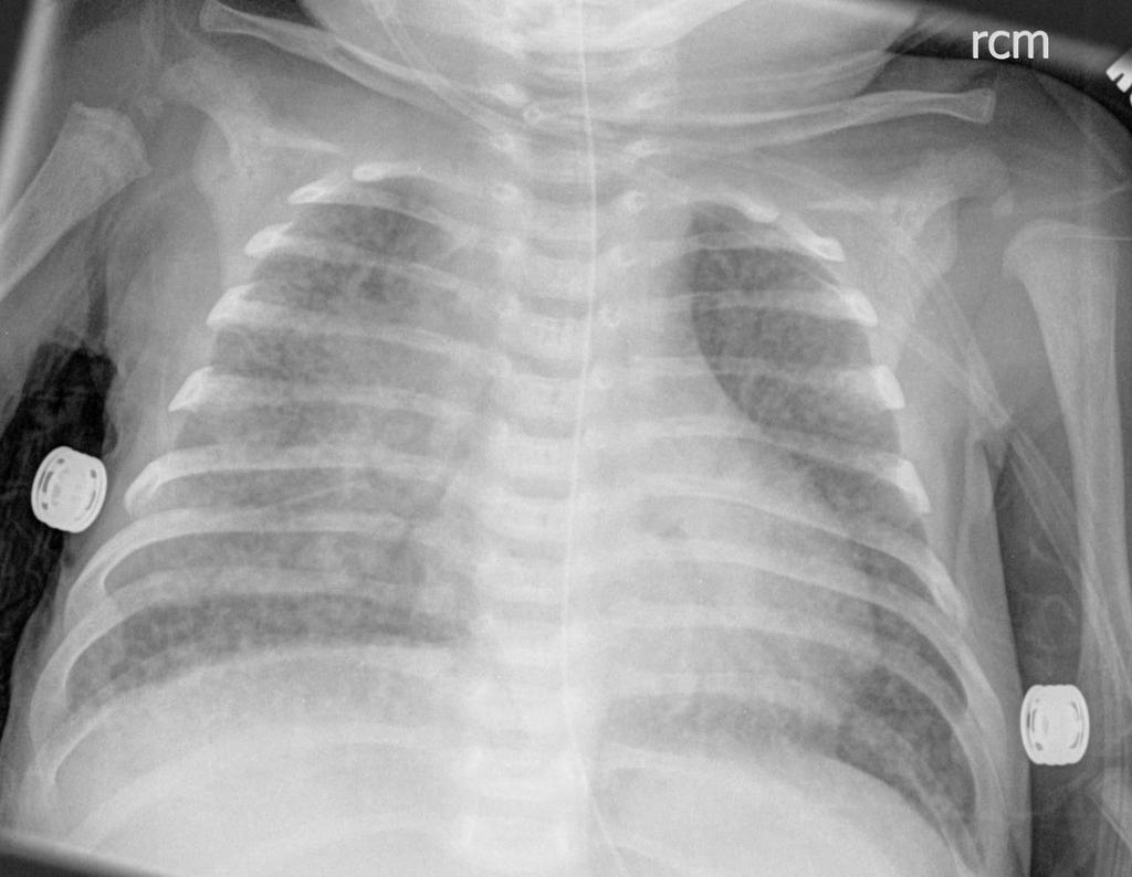2-month-old TB case: adenopathy,