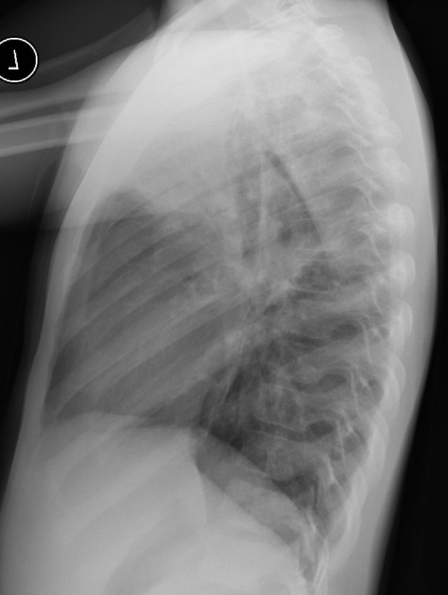 6-year-old TB Case: