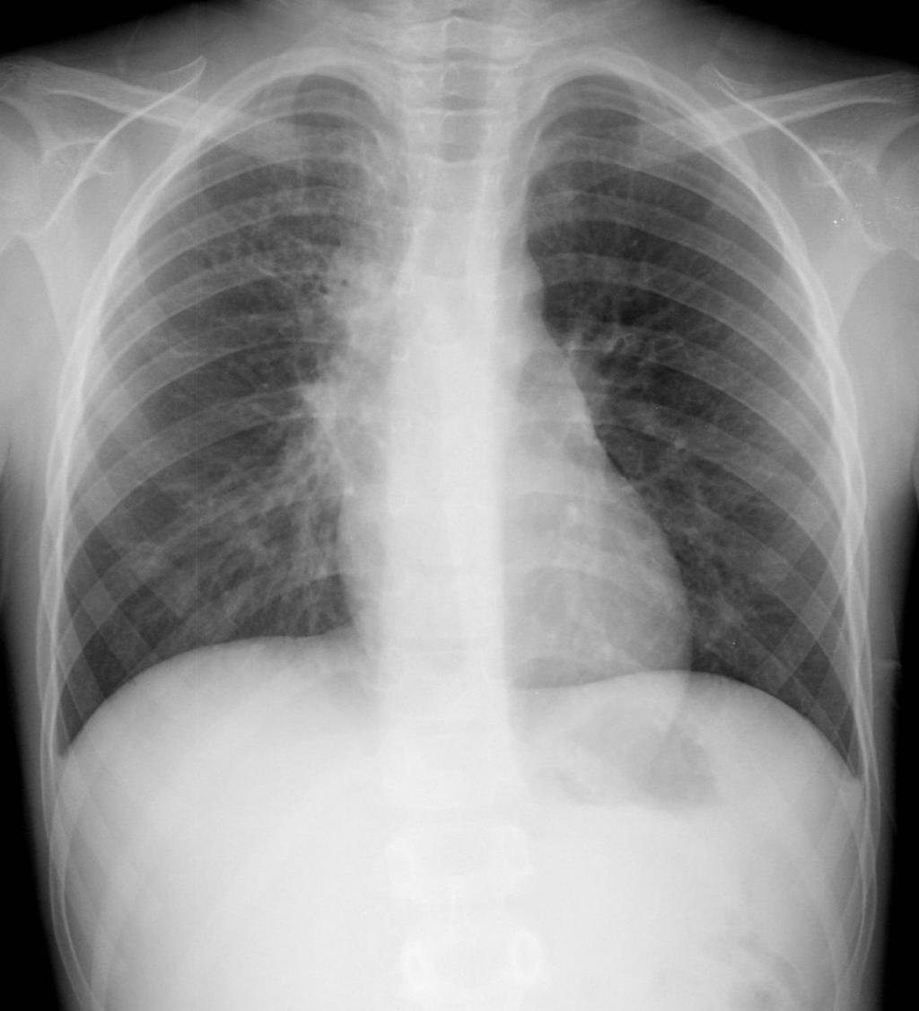 7-year-old TB Case: right hilar/paratracheal adenopathy