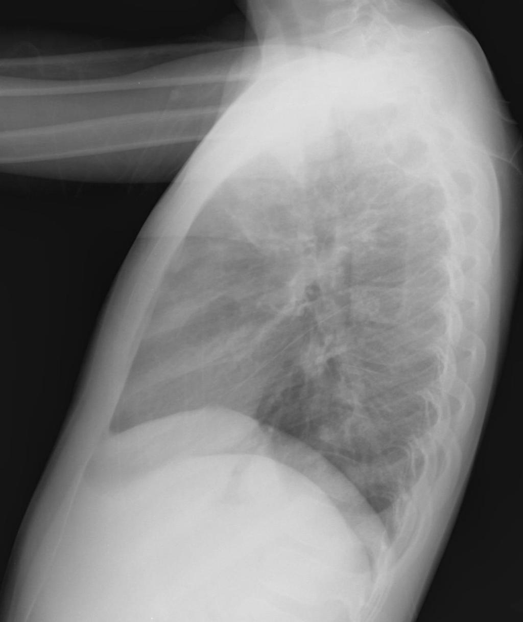 7-year-old TB Case: right