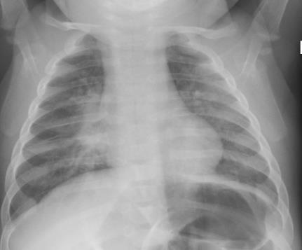 CASE 7: referred because mother may have tuberculosis 5 month old infant whose mother was screened for TB in jail. Mom had a positive IGRA and reportedly had cough.