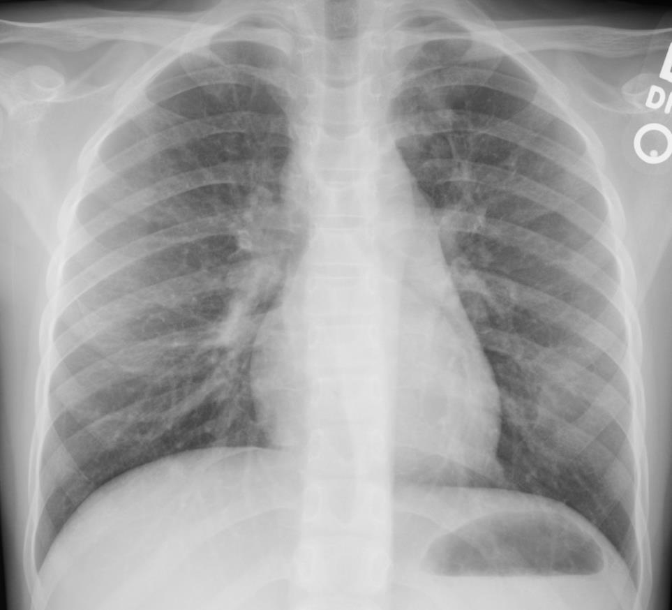 CASE 9: Immigration screening 13 year old Burmese girl Initial chest radiograph for immigration screening was subtly abnormal?