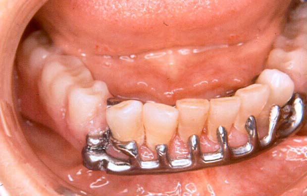 As you can see, the swing lock gate has fingers which contact the labial surfaces of the anterior teeth.
