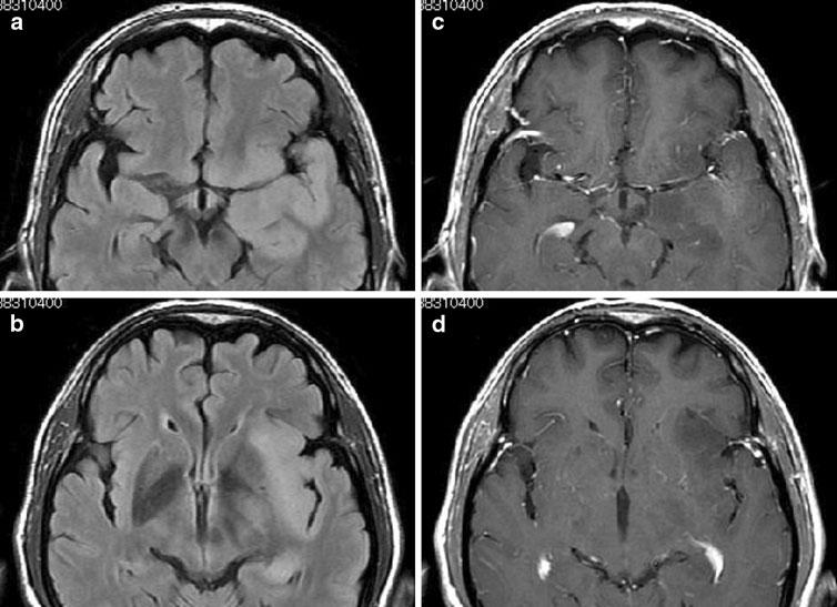 254 Brain Tumor Pathol (2011) 28:253 257 Fig. 1 Preoperative magnetic resonance imaging (MRI).