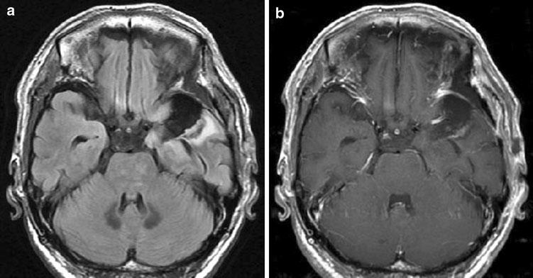 c, d T 1 -weighted images obtained after gadolinium-diethylenetriamine pentaacetic acid (Gd-DTPA) administration show no enhancement Fig. 2 MRI 10 months after operation.