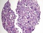 How many tumor blocks from a large tumor should be stained and evaluated?