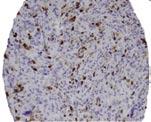 The IHC expression increased from primary tumors to LRs and further in the metastases for Ki-67, cyclin A, p53 and Pgp, but not for bcl-2 and CD44 (Table 16).