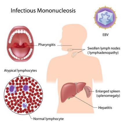 Asymptomatic Spectrum of Clinical Disease Infectious Mononucleosis Malaise and myalgia Fever Pharyngitis with petechiae or exudates