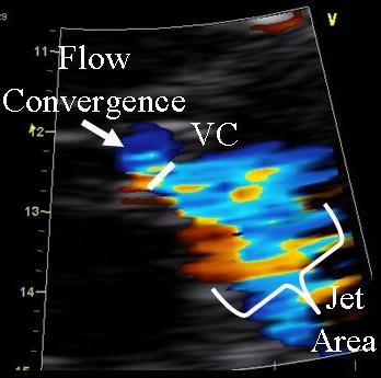 Vena contracta width The narrowest portion of the MR jet downstream from the orifice 2 orthogonal planes Zoom to optimize