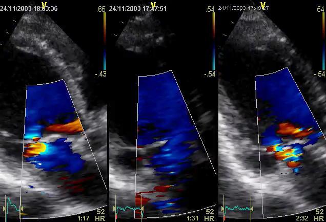 Before CRT Early Late Mitral
