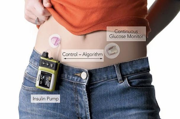 Patients wore the bionic pancreas for 5 days, blood sugars improved