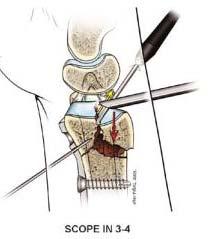 Surgery Fracture reduction Del Piñal et al.
