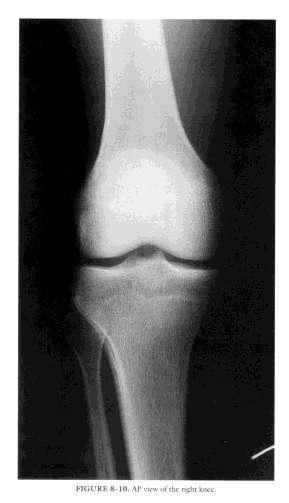 MENISCAL TEAR: IMAGING X-ray MRI To rule out fracture: 2