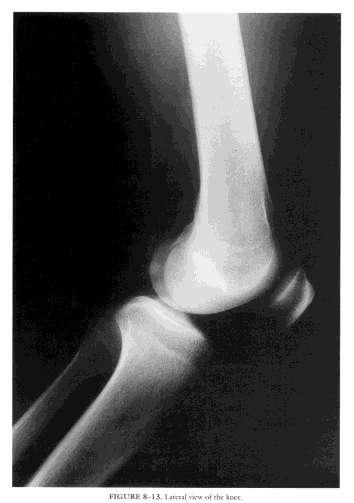 osteoarthritis: 4 view weight bearing McKinnis L.