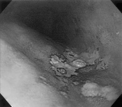 C.C. Chang, et al 77-year-old man with metachronous esophageal cancer and colon cancer treated by EMR.