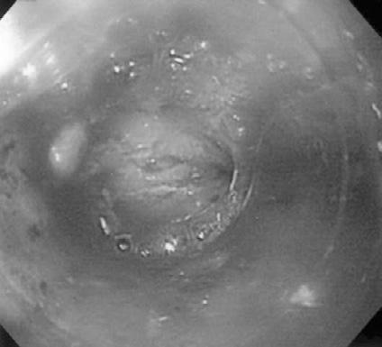 Endoscopic ultrasonography disclosed neither obvious thickening of the esophageal wall nor obvious lymph nodes.