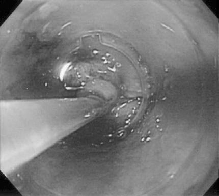 Initially, 20 ml of glycerol was injected into the submucosa of the lesion with a 23-G injector (NM-200L-0423, Olympus Optical Co., Ltd., Tokyo, Japan) to elevate this lesion.