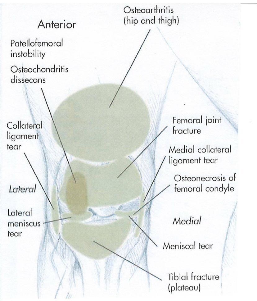 Lateral Knee Pain Lateral Femoral condyle suggests IT