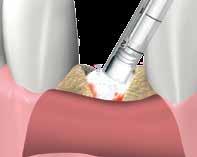 ADVANTAGES INDICATIONS BONDBONE is a resorbable, osteoconductive bone grafting material taking the